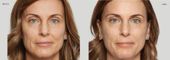Before & After Sculptra Case 204 View 1 View in Santa Rosa, California