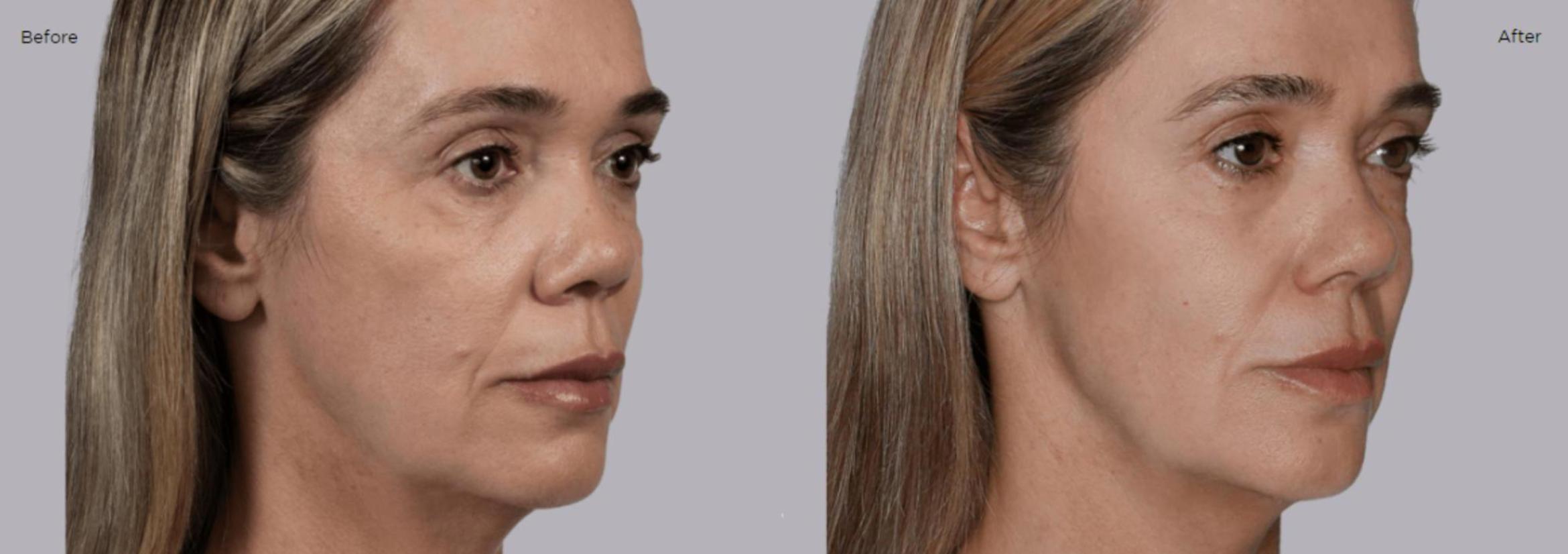 Before & After Sculptra Case 205 View 1 View in Santa Rosa, California