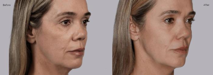 Before & After Sculptra Case 205 View 1 View in Santa Rosa, California