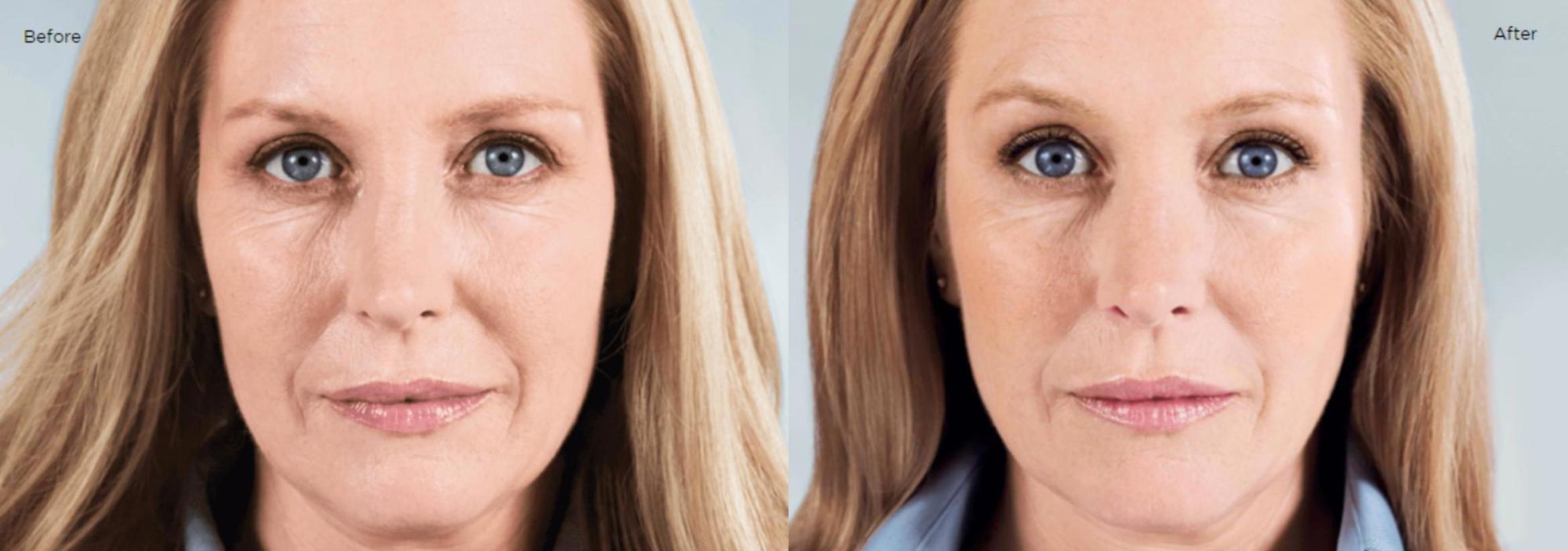 Before & After Sculptra Case 206 View 1 View in Santa Rosa, California