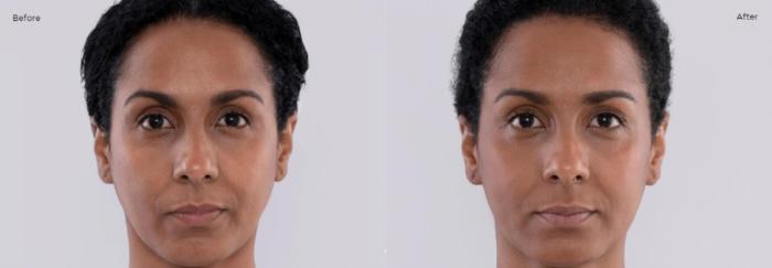 Before & After Sculptra Case 207 View 1 View in Santa Rosa, California