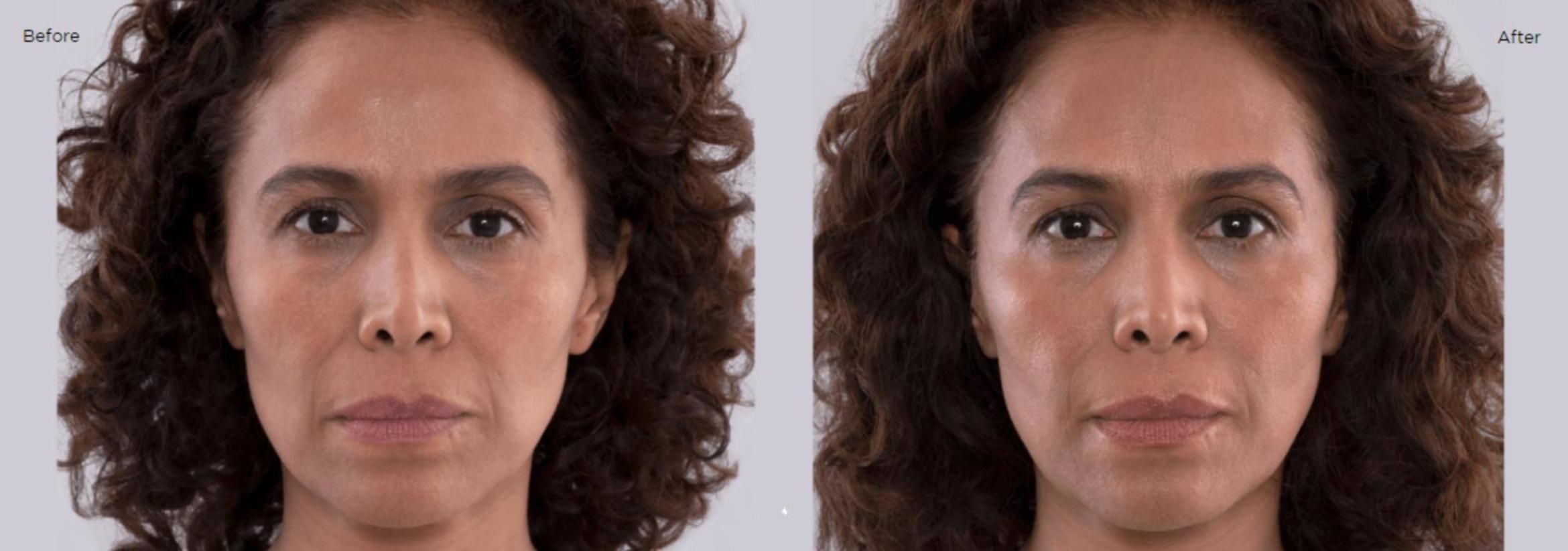 Before & After Sculptra Case 208 View 1 View in Santa Rosa, California