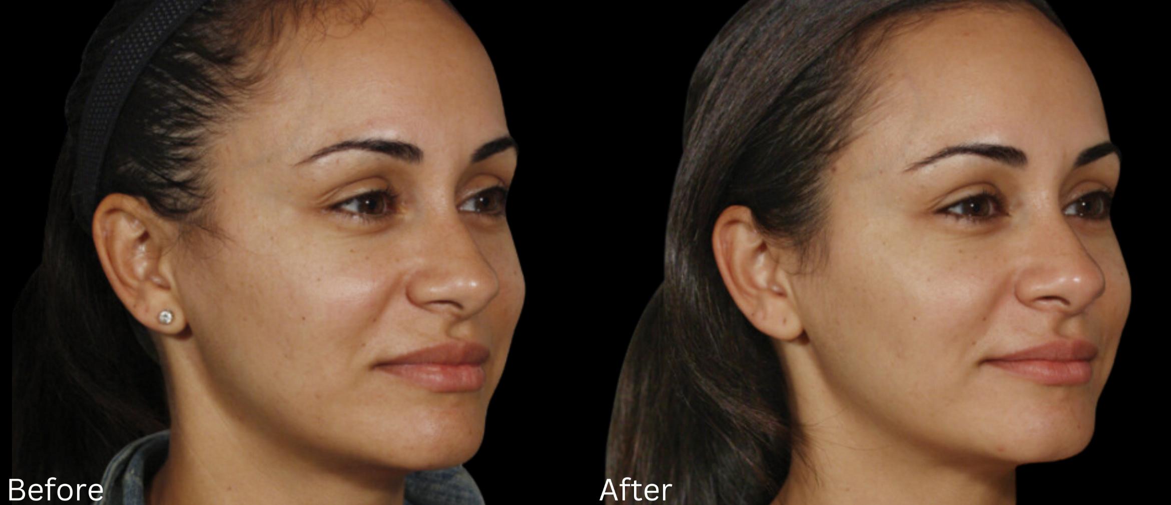 Before & After Sculptra Case 326 View 1 View in Santa Rosa, California