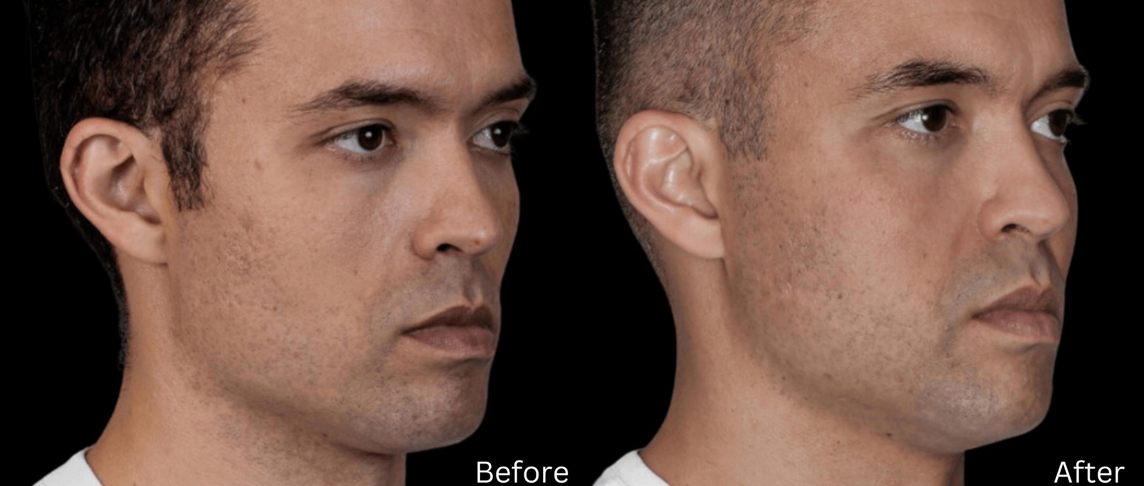 Before & After Sculptra Case 327 View 1 View in Santa Rosa, California