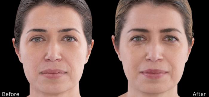 Before & After Sculptra Case 328 View 1 View in Santa Rosa, California