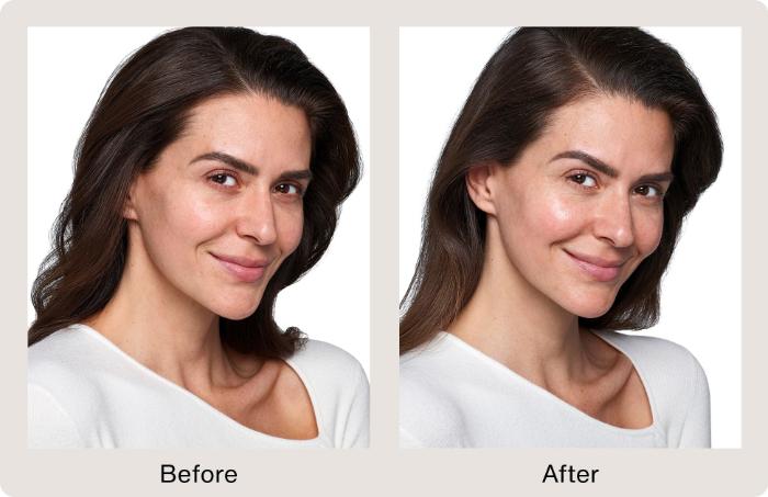 Before & After SkinVive Case 209 View 1 View in Santa Rosa, California
