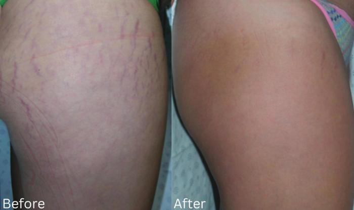 Before & After Stretch Marks Case 198 View 1 View in Santa Rosa, California