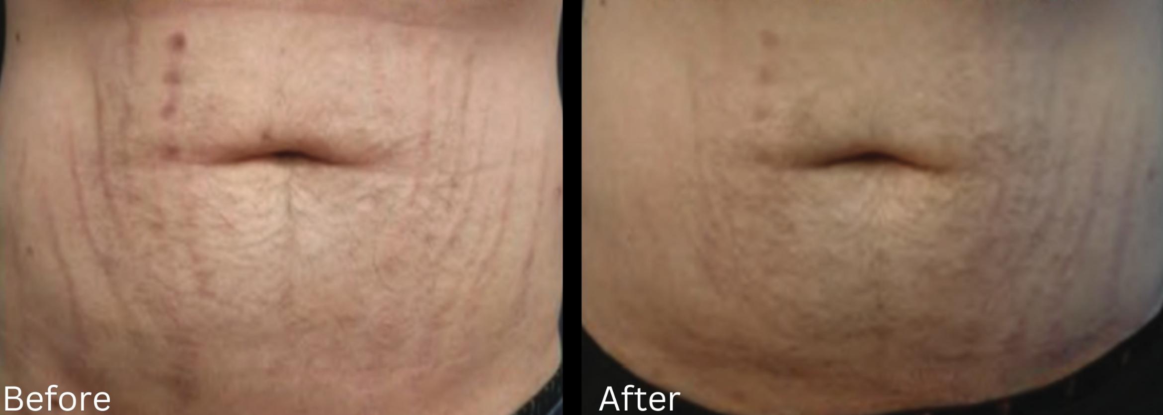 Before & After Stretch Marks Case 361 View 1 View in Santa Rosa, California
