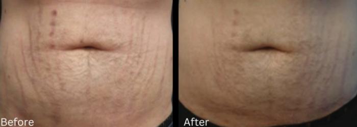 Before & After Stretch Marks Case 361 View 1 View in Santa Rosa, California