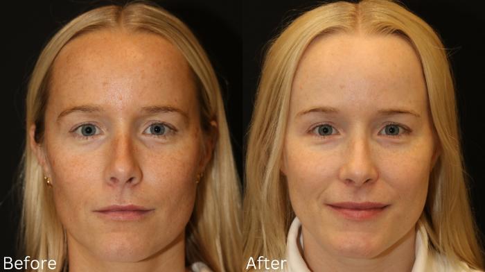 Before & After Sun Damage Case 234 View 1 View in Santa Rosa, California