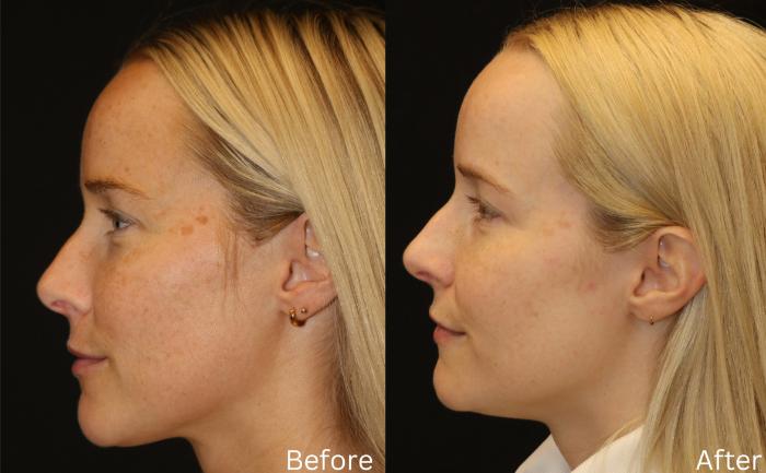 Before & After Sun Damage Case 234 View 2 View in Santa Rosa, California