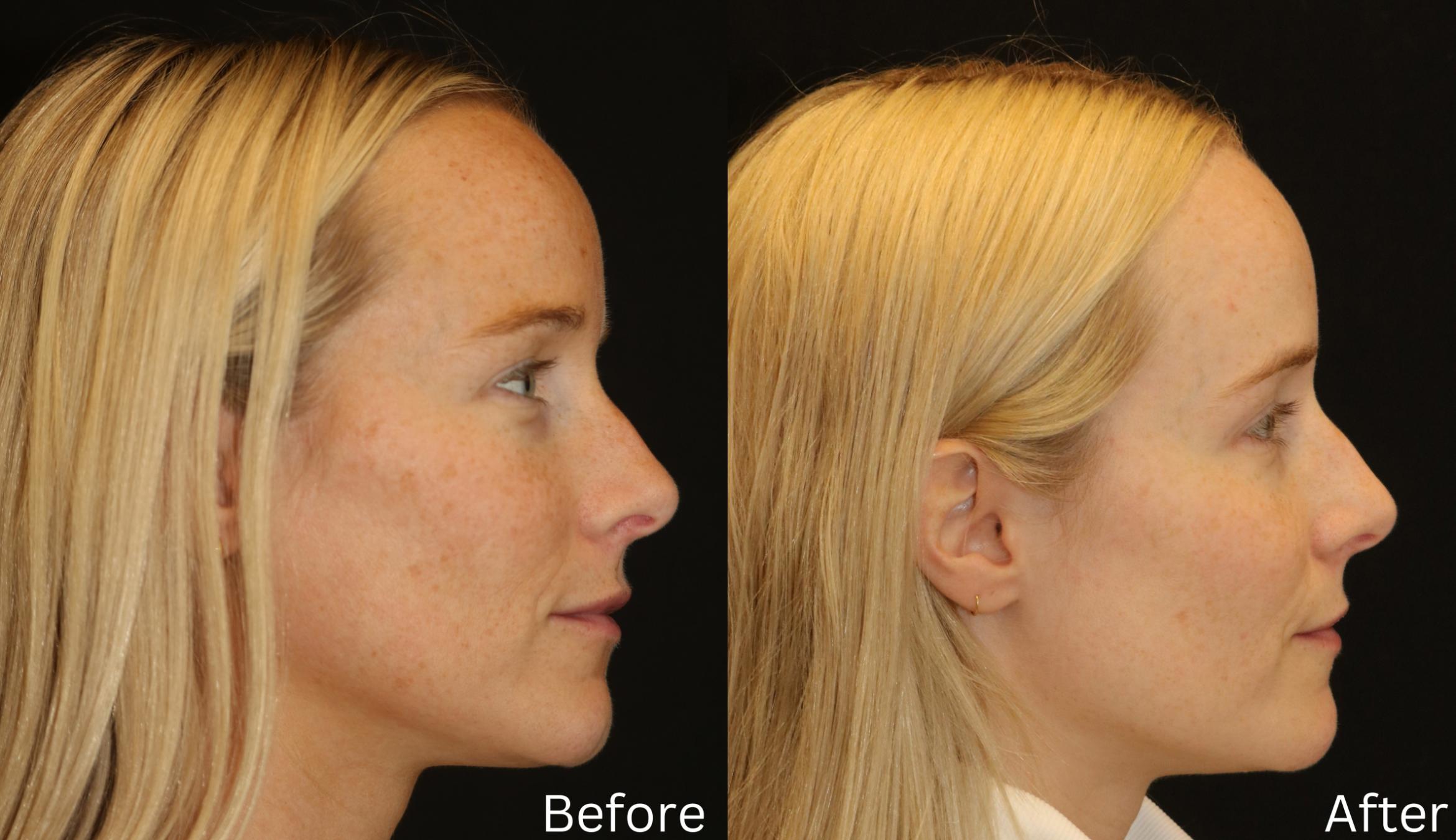 Before & After Sun Damage Case 234 View 3 View in Santa Rosa, California