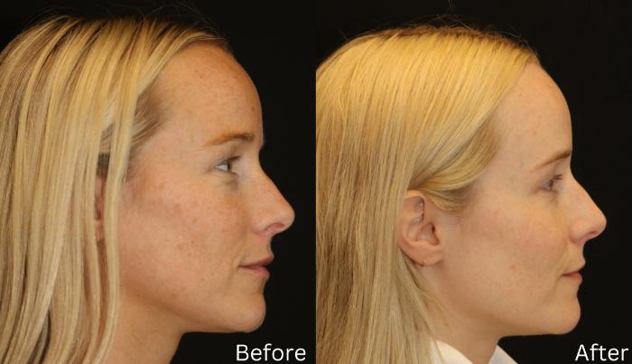 Before & After Sun Damage Case 234 View 3 View in Santa Rosa, California