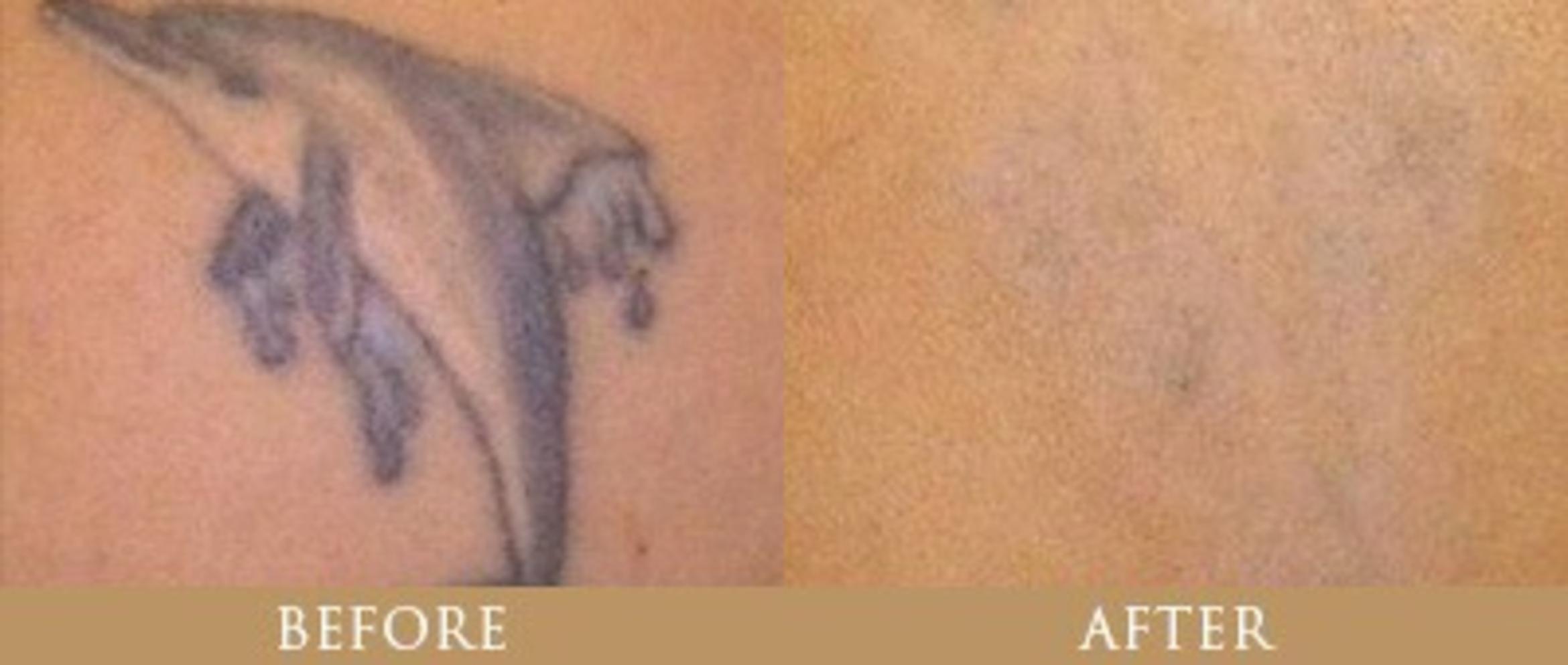 Before & After Tattoo Removal Case 139 View 1 View in Santa Rosa, California