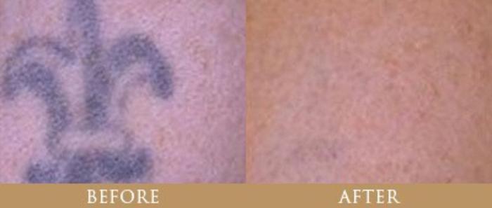 Before & After Tattoo Removal Case 140 View 1 View in Santa Rosa, California