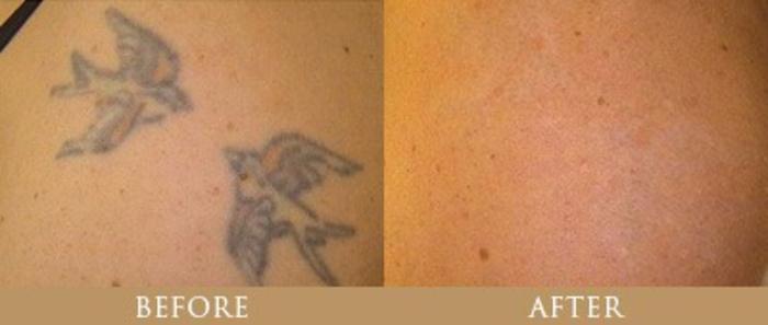 Before & After Tattoo Removal Case 141 View 1 View in Santa Rosa, California