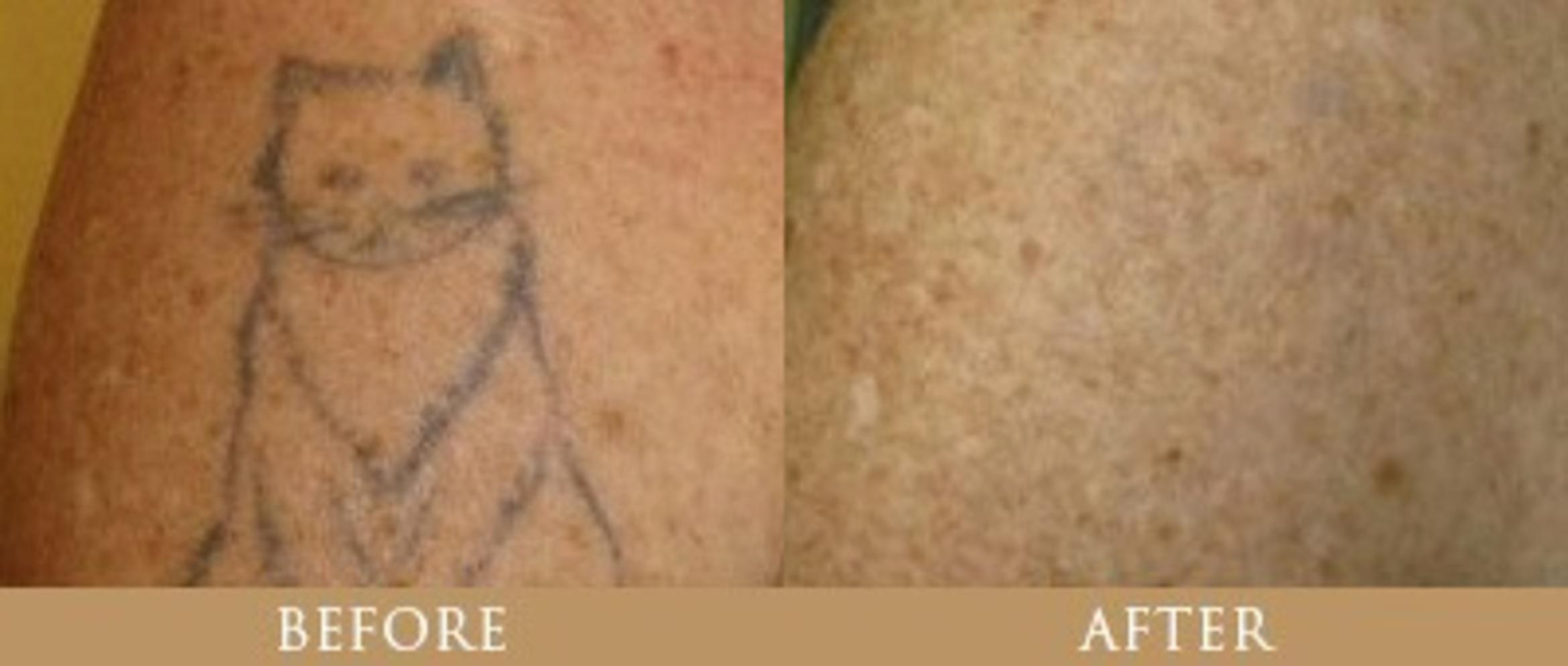 Before & After Tattoo Removal Case 142 View 1 View in Santa Rosa, California