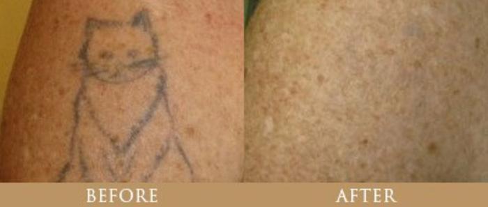 Before & After Tattoo Removal Case 142 View 1 View in Santa Rosa, California