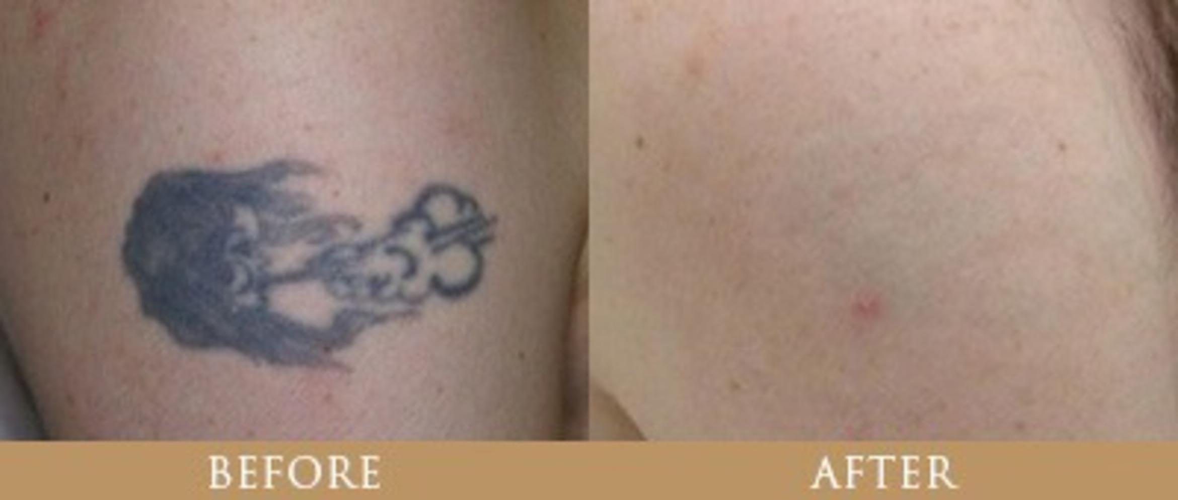 Before & After Tattoo Removal Case 143 View 1 View in Santa Rosa, California