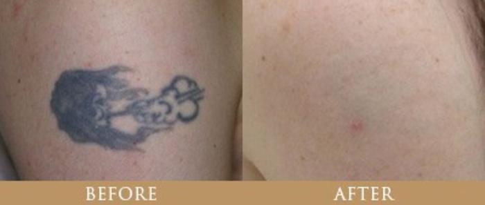 Before & After Tattoo Removal Case 143 View 1 View in Santa Rosa, California