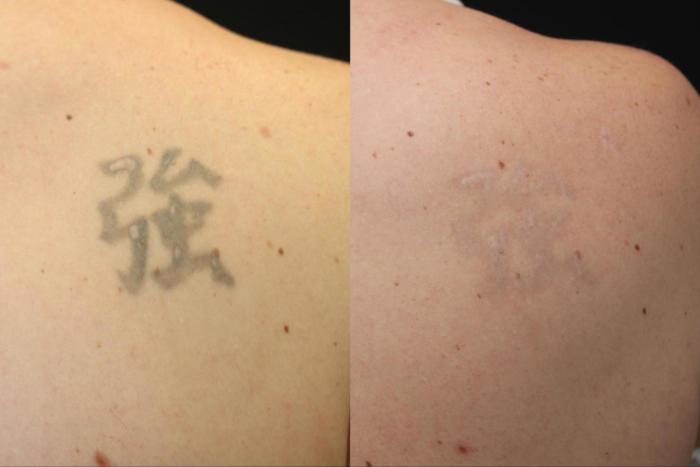 Before & After Tattoo Removal Case 391 View 1 View in Santa Rosa, California