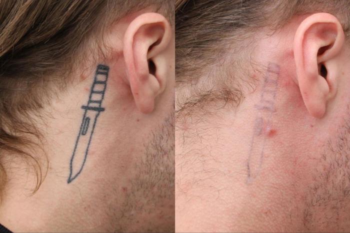 Before & After Tattoo Removal Case 392 View 1 View in Santa Rosa, California