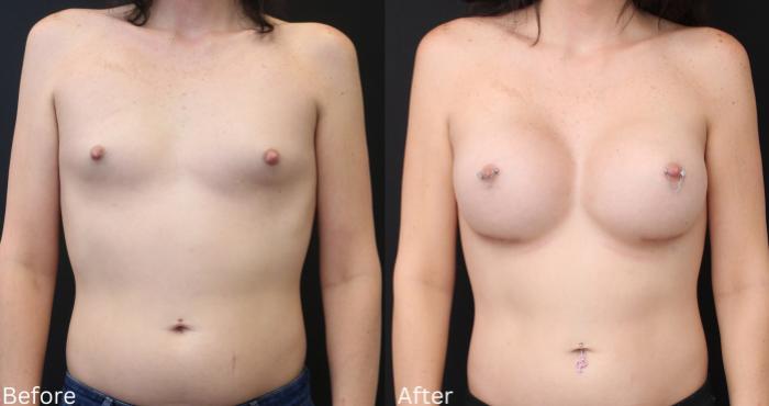 Before & After Transgender Breast Augmentation Case 177 View 1 View in Santa Rosa, California