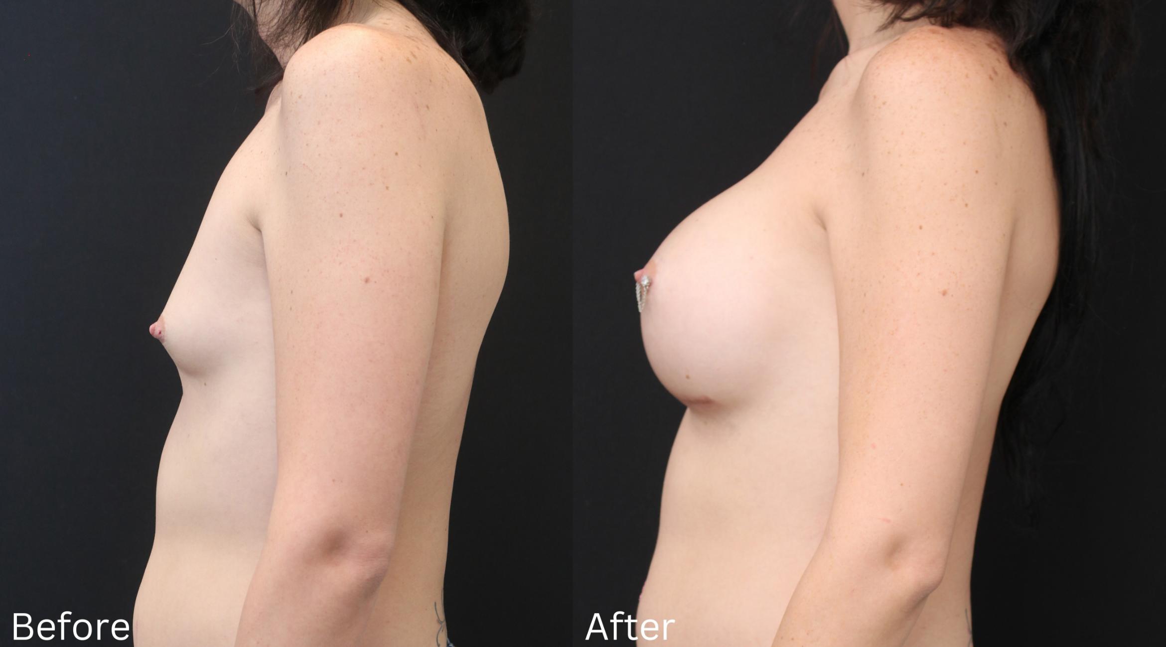 Before & After Transgender Breast Augmentation Case 177 View 2 View in Santa Rosa, California