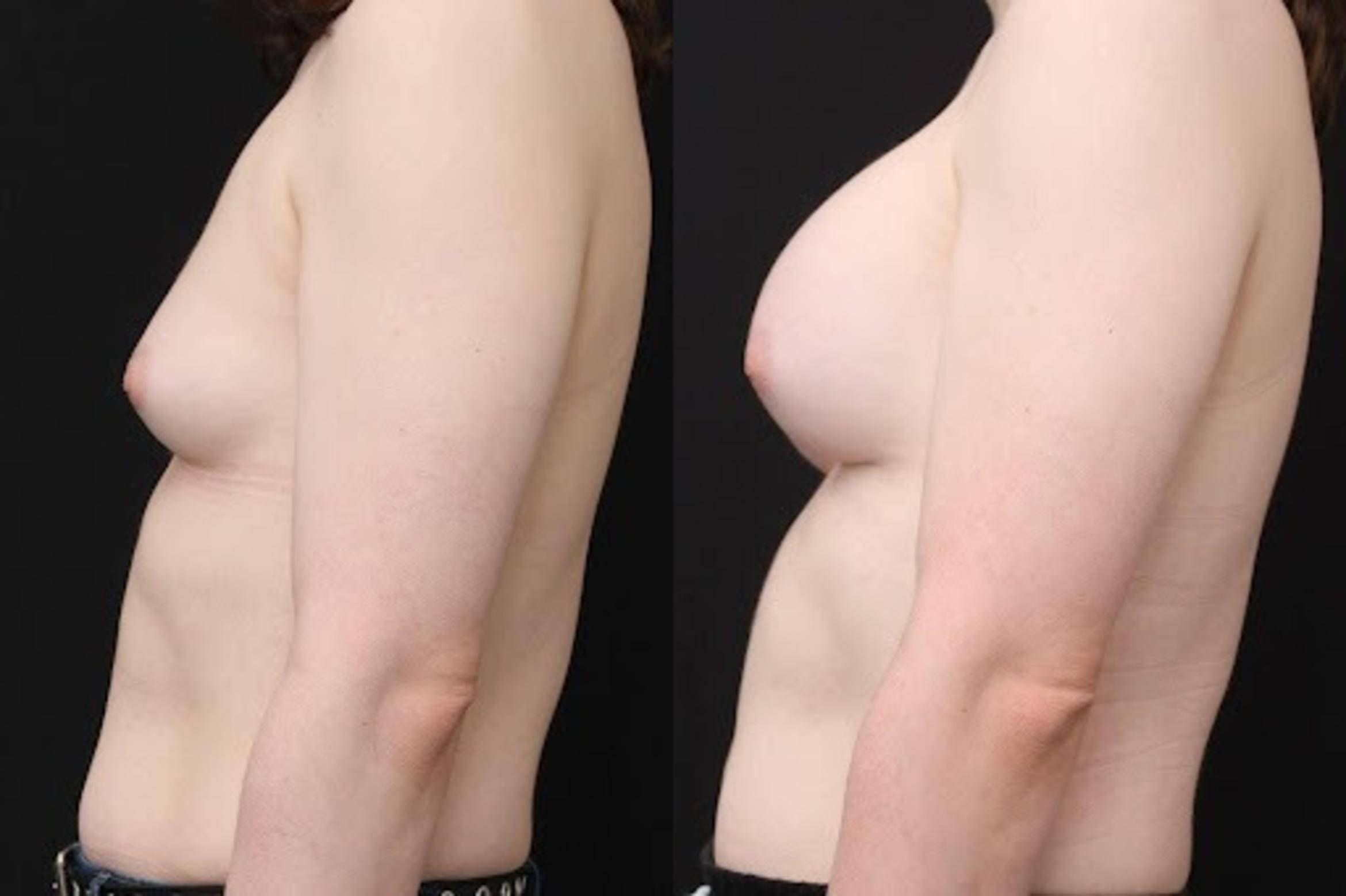 Before & After Transgender Breast Augmentation Case 264 View 2 View in Santa Rosa, California