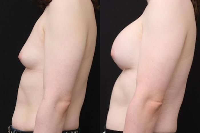 Before & After Transgender Breast Augmentation Case 264 View 2 View in Santa Rosa, California