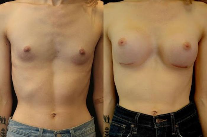 Before & After Transgender Breast Augmentation Case 265 View 1 View in Santa Rosa, California