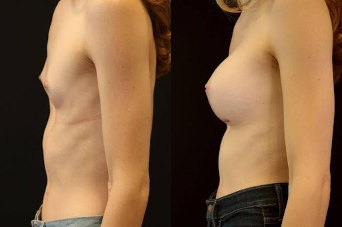 Before & After Transgender Breast Augmentation Case 265 View 2 View in Santa Rosa, California