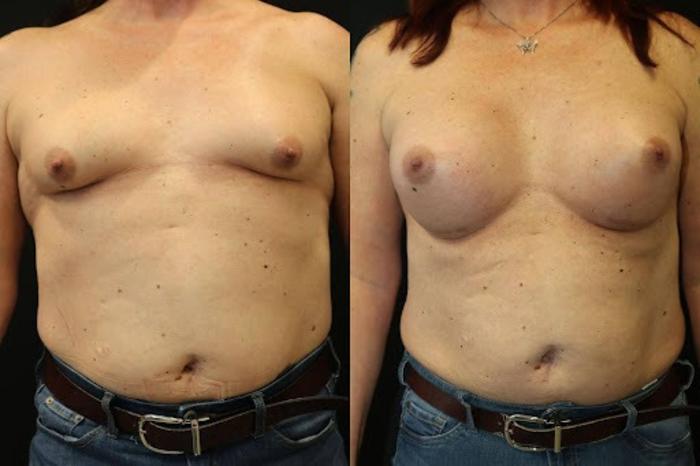 Before & After Transgender Breast Augmentation Case 284 View 1 View in Santa Rosa, California