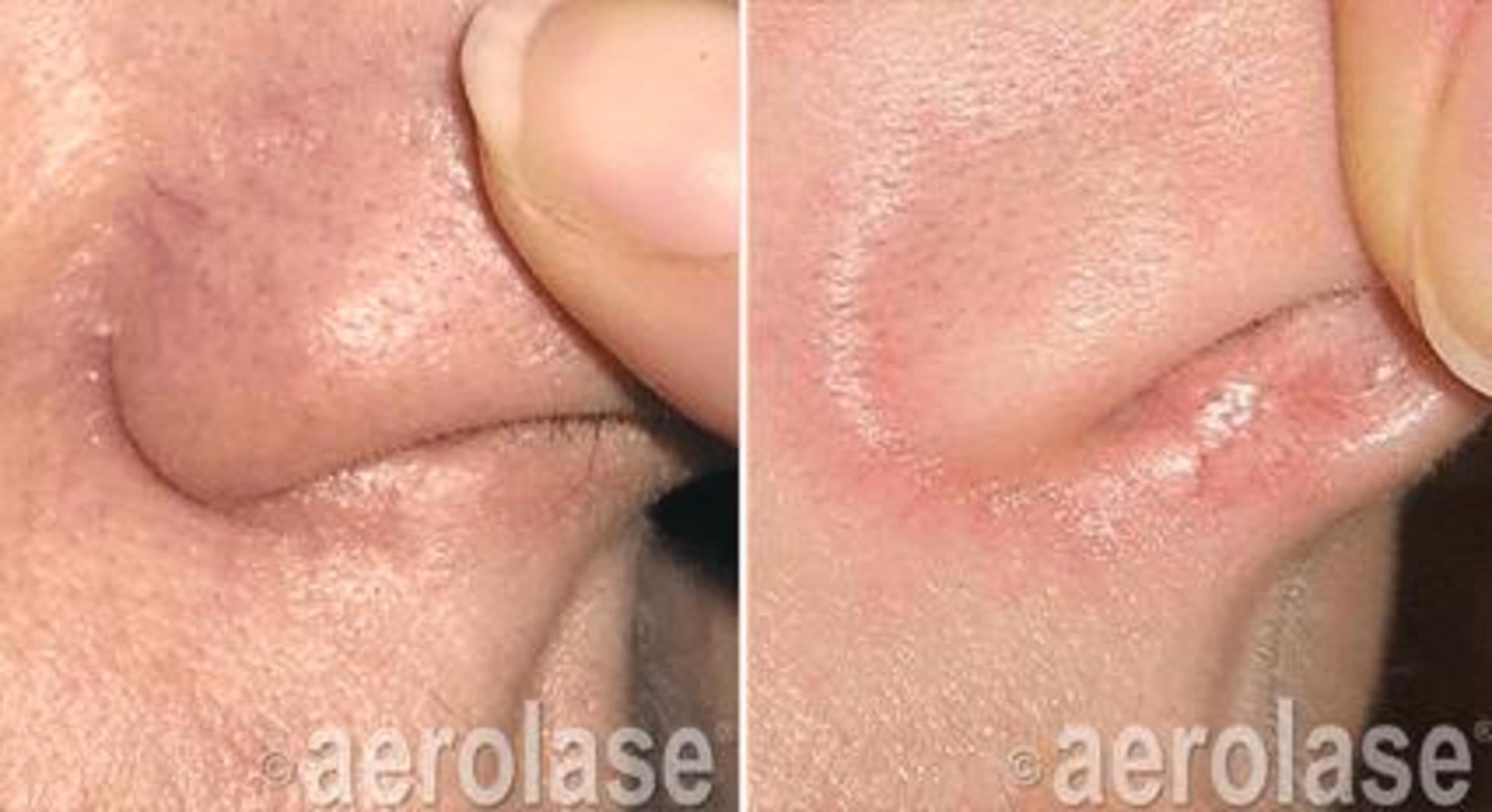 Before & After Veins & Lesions Case 362 View 1 View in Santa Rosa, California