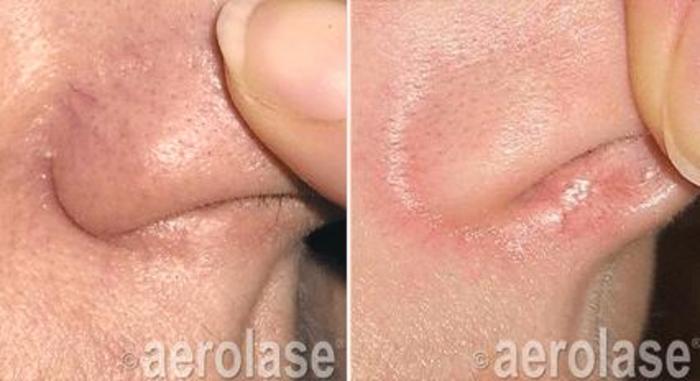 Before & After Veins & Lesions Case 362 View 1 View in Santa Rosa, California