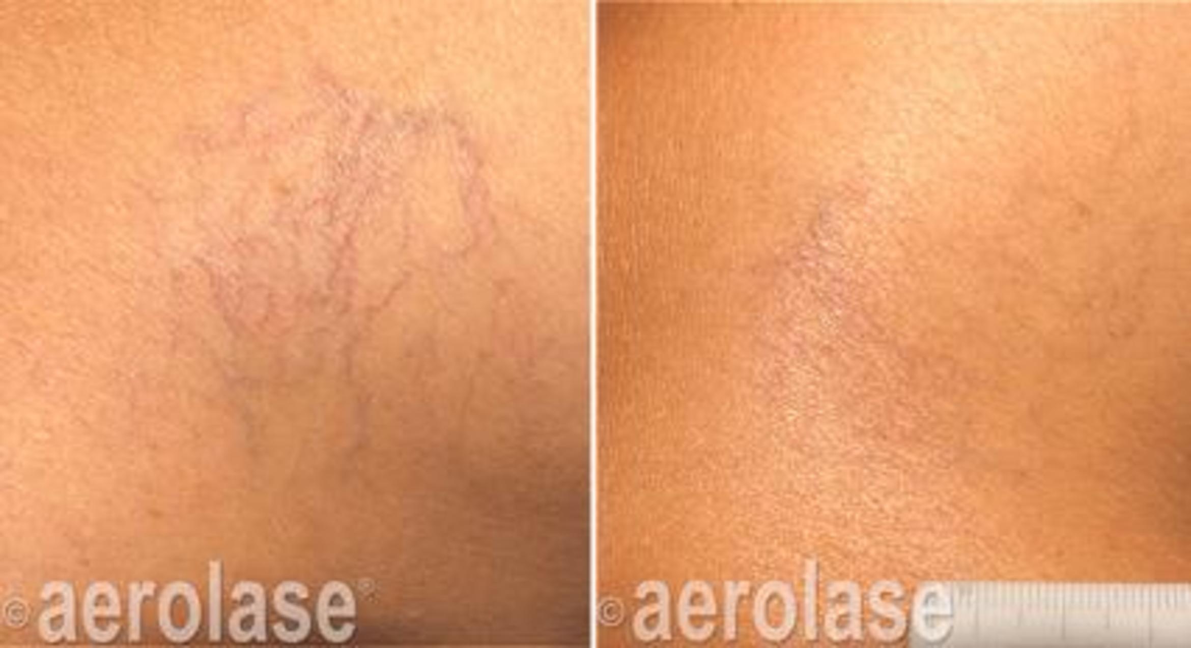 Before & After Veins & Lesions Case 363 View 1 View in Santa Rosa, California