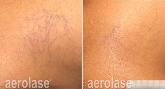 Before & After Veins & Lesions Case 363 View 1 View in Santa Rosa, California