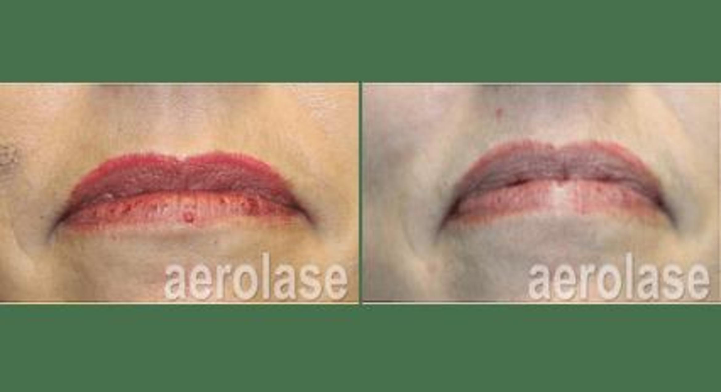 Before & After Veins & Lesions Case 364 View 1 View in Santa Rosa, California