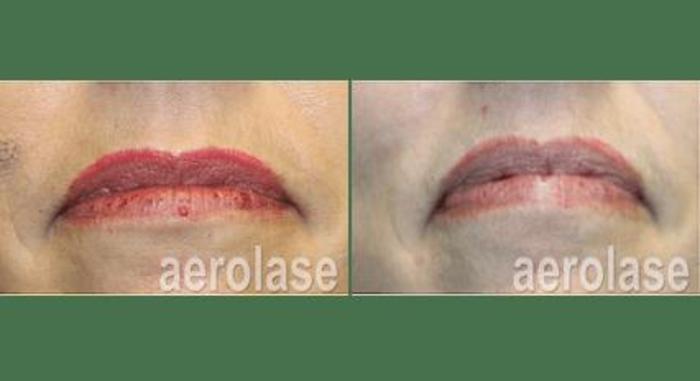 Before & After Veins & Lesions Case 364 View 1 View in Santa Rosa, California