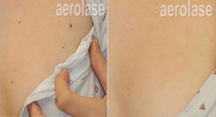 Before & After Veins & Lesions Case 365 View 1 View in Santa Rosa, California