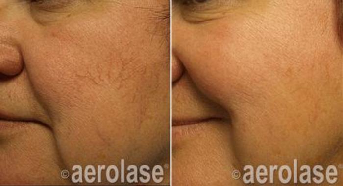 Before & After Veins & Lesions Case 366 View 1 View in Santa Rosa, California