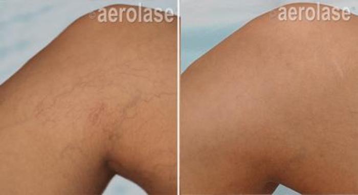 Before & After Veins & Lesions Case 367 View 1 View in Santa Rosa, California