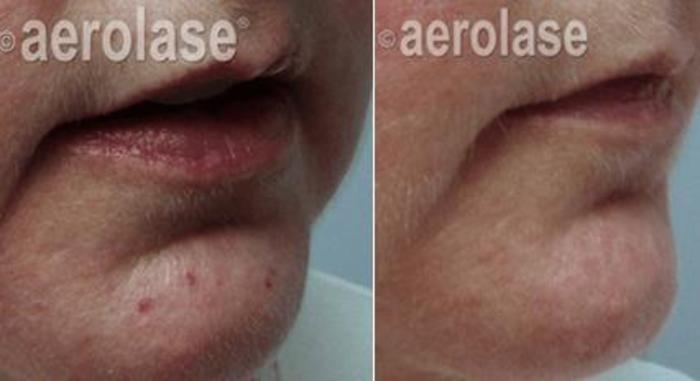 Before & After Veins & Lesions Case 368 View 1 View in Santa Rosa, California
