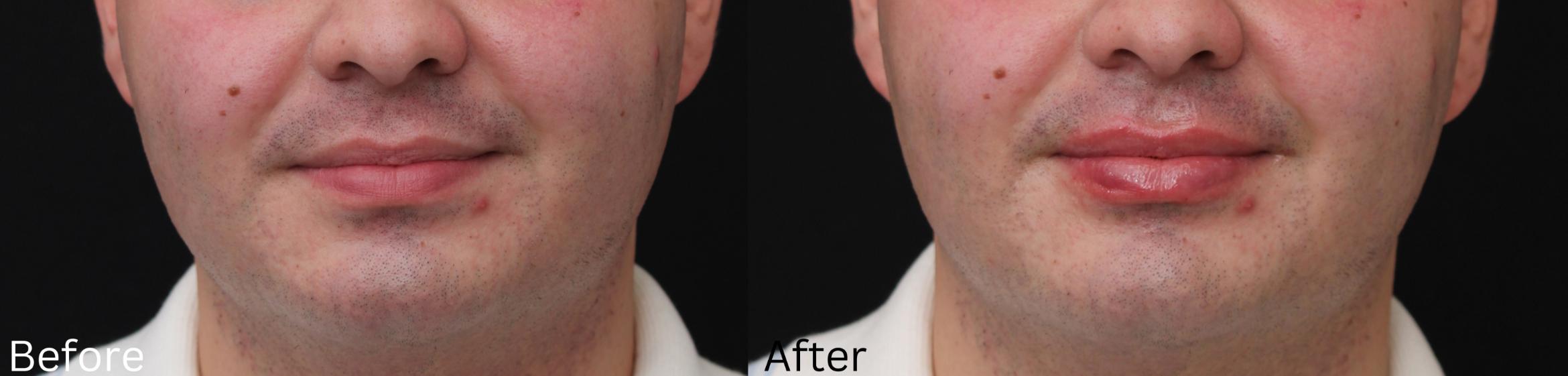 Before & After Volbella Case 235 View 1 View in Santa Rosa, California