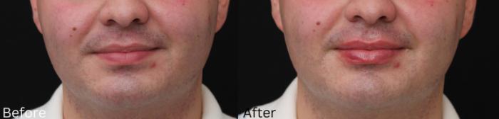Before & After Volbella Case 235 View 1 View in Santa Rosa, California