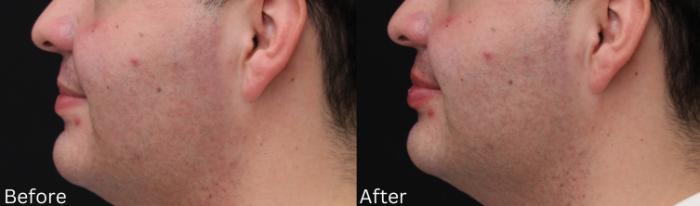 Before & After Volbella Case 235 View 2 View in Santa Rosa, California
