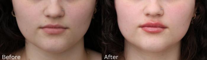 Before & After Volbella Case 236 View 1 View in Santa Rosa, California