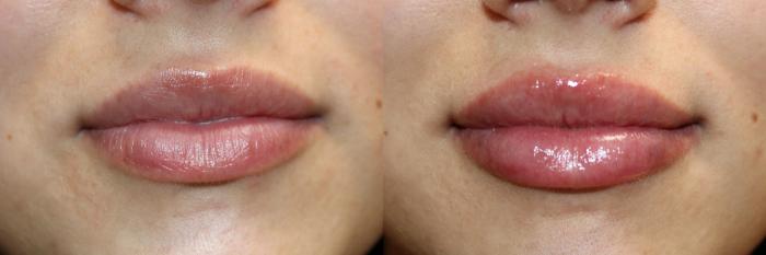 Before & After Volbella Case 435 Front View in Santa Rosa, California