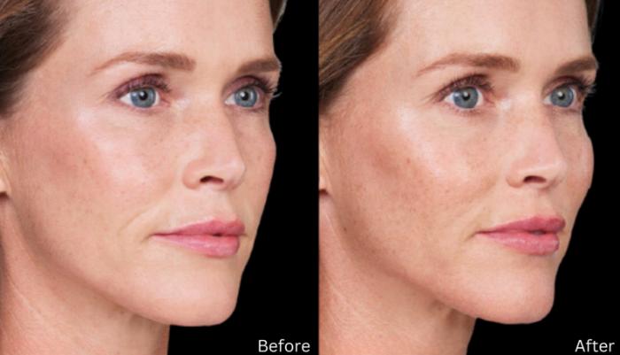 Before & After Vollure Case 330 View 1 View in Santa Rosa, California