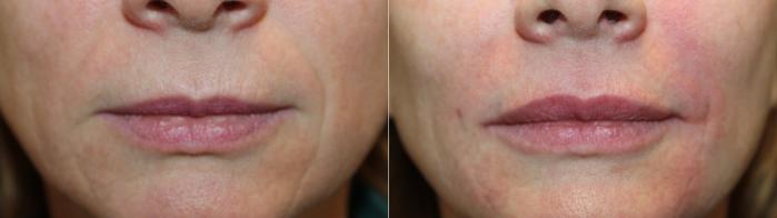 Before & After Juvederm Filler Case 426 Front View in Santa Rosa, California